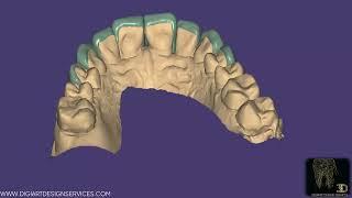 Exocad : Desiging Perfect Veneers 8 units