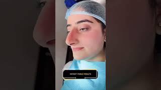 Liquid Rhinoplasty (Nose Job) in South Delhi by Dr. Adarsh Tripathi #nosecorrection #nose #nosejob
