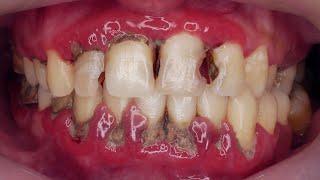 SCALING GIGI DEPAN | Dentist | Dokter Gigi Tri Putra