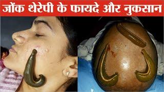 जोंक थेरेपी के फायदे और नुकसान | Leech therapy benefits | Jonk therapy