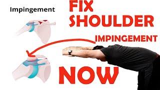 Shoulder impingement