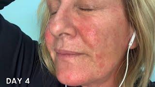 Days 3-5 | Fluorouracil with calcipotriene Actinic Keratosis treatment