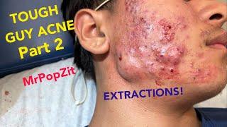 Very severe acne in a preteen patient.Follow his progress.Extractions of blackheads and whiteheads.