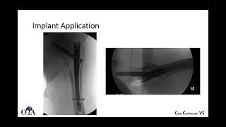 Intertrochanteric femur fractures - 1 of 3