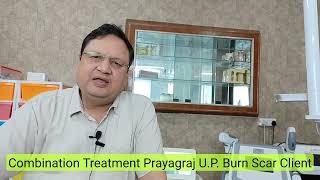 Results Burn Scar Combination Treatment | Prayagraj U.P. | Keloid | Hypertrophic Scar | Kayakalp