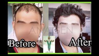 Hair Transplant // Before After // Mumbai// #hairtransplant #mumbaihairtransplant #shorts