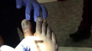 Toe Nail Removal for Onychomycosis