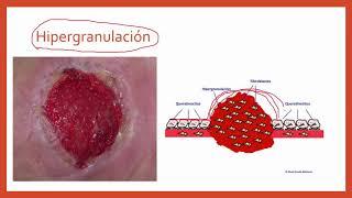 Repaso Cicatrización y sus fases