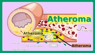 atheroma