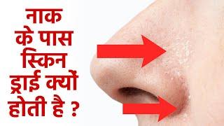 नाक के आसपास ड्राई स्किन क्यों होती है | Naak Ke Pass Dry Skin Kyu Hoti Hai | Boldsky