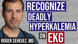 Hyperkalemia - Peaked T-Waves - and ECG Recognition