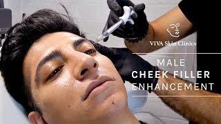 Male Cheek Filler Enhancement | VIVA Skin Clinics