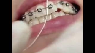 How to use Dental Floss Threader