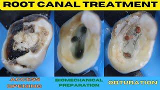 Root Canal Treatment in Grossly Carious Tooth 🟡 How To Save Badly Decayed Tooth 🟠 Step By Step Demo