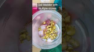 Gall bladder with Multiple stones #healthmedia