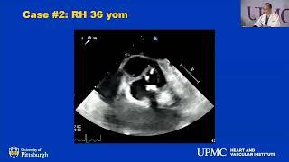 17 -Endocarditis with IV Drug Use: We need to talk about it! - Pyongsoo Yoon, MD