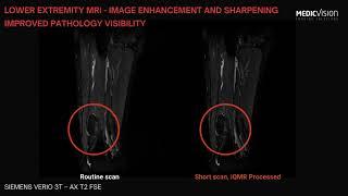 Enhanced Lower Extremity MRI scans Improve Intramuscular lipoma visibility