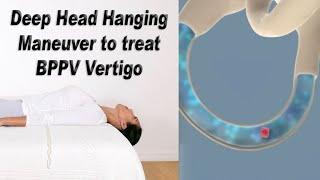 Deep Head Hanging Maneuver to Treat BPPV Vertigo