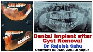 Dental Implant Planning After OKC (Cyst) Removal From Jaw