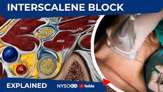 Ultrasound-Guided Continuous Interscalene Brachial Plexus Block - Regional Anesthesia