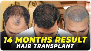 Hair Transplant in Delhi | Best Results & Cost of Hair Transplant in Delhi