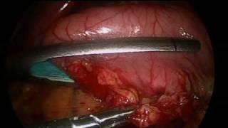 Sleeve Gastrectomy in Male BMI 52 by Dr Craig Taylor OClinic Sydney.mp4