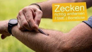 Zecken entfernen mit Pinzette & Zeckenzange  FSME & Borreliose vermeiden