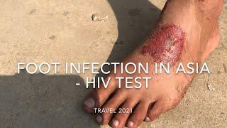 Foot Infections and HIV - Travelling SouthEast Asia 2021 / Medical Tips Laos