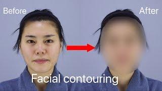 Face Contouring and Rhinoplasty  | Seoul Guide Medical