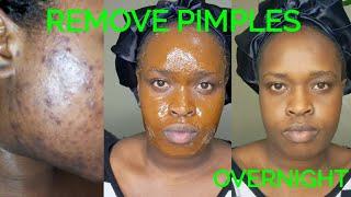 How to remove pimples overnight/ Acne treatment