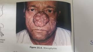 RHINOPHYMA -EXAM NOTES