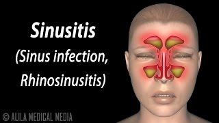 Sinusitis, Animation.