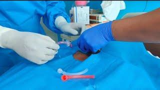 Tracheostomy  Care II Home care of tracheostomy tube II Tracheostomy Suctioning
