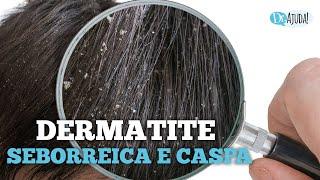 DERMATITE SEBORREICA E CASPA: QUAIS SÃO AS CAUSAS E O QUE FAZER?