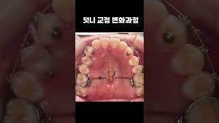 덧니교정 변화과정