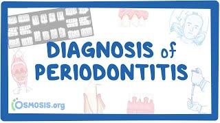 Diagnosis of Periodontitis