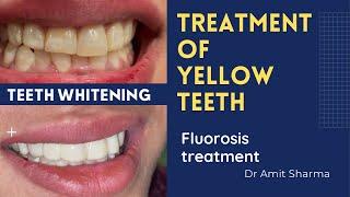 How dentist make yellow teeth white ?  Teeth whitening | Fluorosis treatment