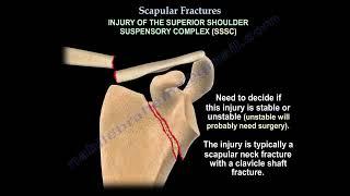 Scapular Fractures: Classification, Diagnosis, and Management