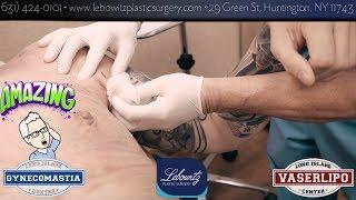 Post Op Vaser Lipo & Gland Removal At Gynecomastia Center Long Island Huntington NY by Dr Lebowitz