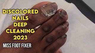 CLEANING TOENAIL :  DISCOLORED TOENAILS DEEP CLEANING BY FAMOUS PODIATRIST MISS FOOT FIXER