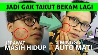 3 CARA MENGHILANGKAN & MEMBASMI JERAWAT PRIA CEPAT, ALAMI DENGAN BEKAM | AFA Rez