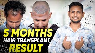 Hair Transplant in Indore | Best Results & Cost of Hair Transplant in Indore