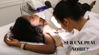 CE QU'IL FAUT SAVOIR SUR L' EPILATION DEFINITIVE! PEAU NOIRE