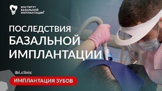 Какие последствия у базальной имплантации? | Институт базальной имплантации