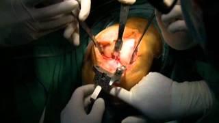 Knee Surgery: Mobile Bearing Total Knee Arthroplasty