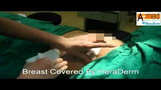 Breast Covered By HeraDerm