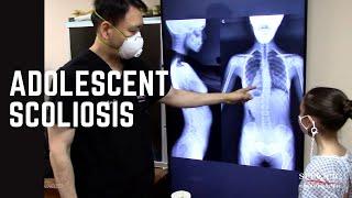 Adolescent Non surgical scoliosis treatment by Dr Suh Gonstead Manhattan Chiropractic NYC