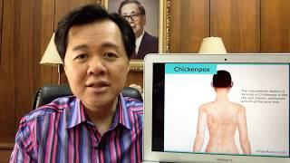 Chicken Pox: What to Do?  by Dr Willie Ong