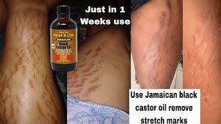 Stretch mark removal / how to remove stretch mark with Jamaican black castor oil #stretchmarks