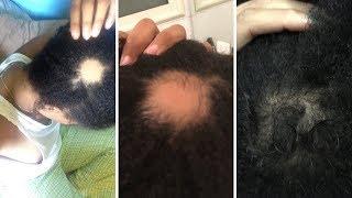 My Bald Spot Journey!